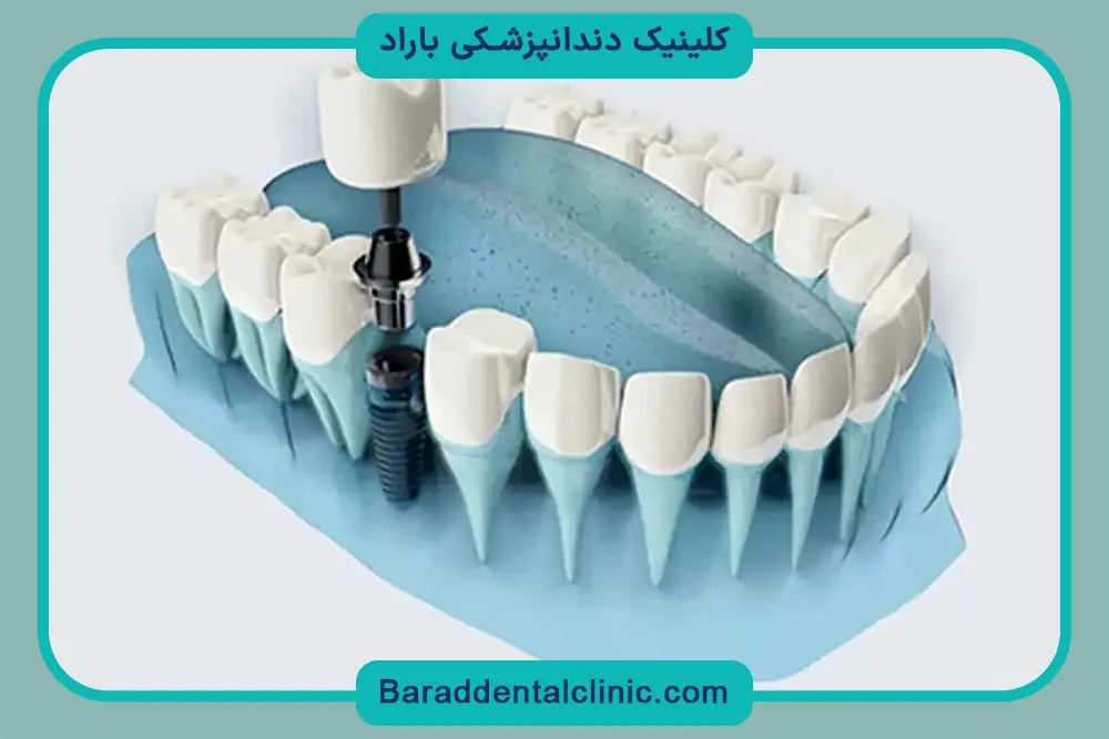 ایمپلنت دیجیتال اقساطی