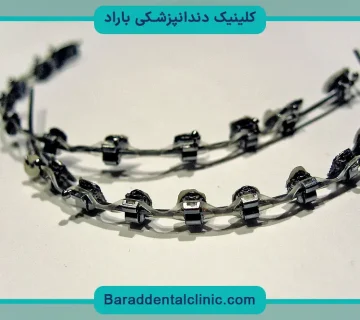 براکت فلزی دندان