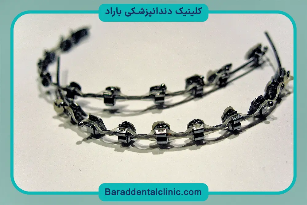 براکت فلزی دندان