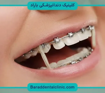 کش براکت دندان