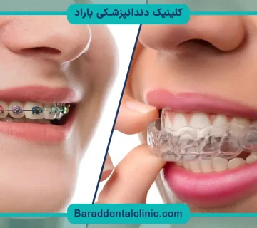 براکت نامرئی دندان
