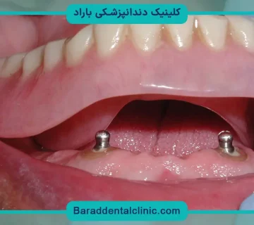 پایه دندان چیست