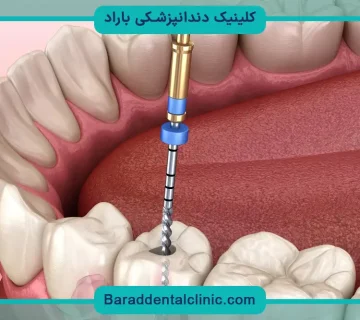 پایه دندان برای عصب کشی