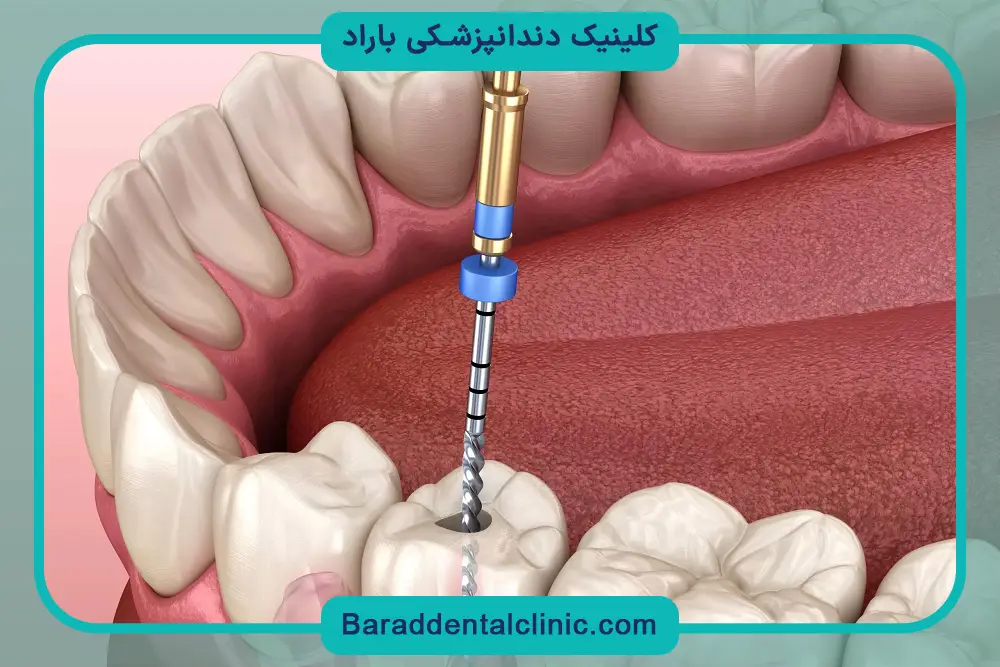 پایه دندان برای عصب کشی