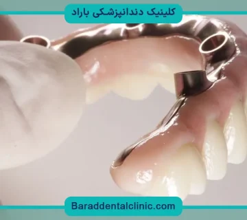 پایه دندان روکش