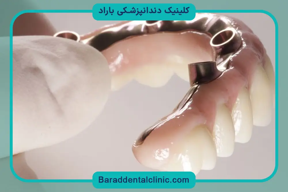 پایه دندان روکش