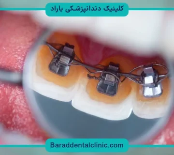 براکت ارتودنسی پشت دندان