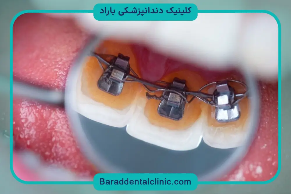 براکت ارتودنسی پشت دندان