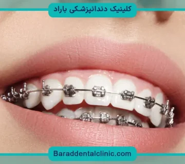 براکت دندان چیست