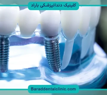 ایمپلنت دیجیتال تهران
