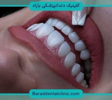 بهترین مارک کامپوزیت ونیر دندان