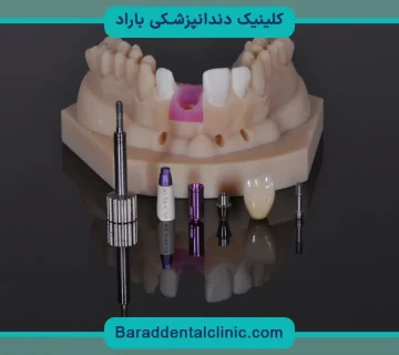 فرق ایمپلنت دیجیتال با پانچ