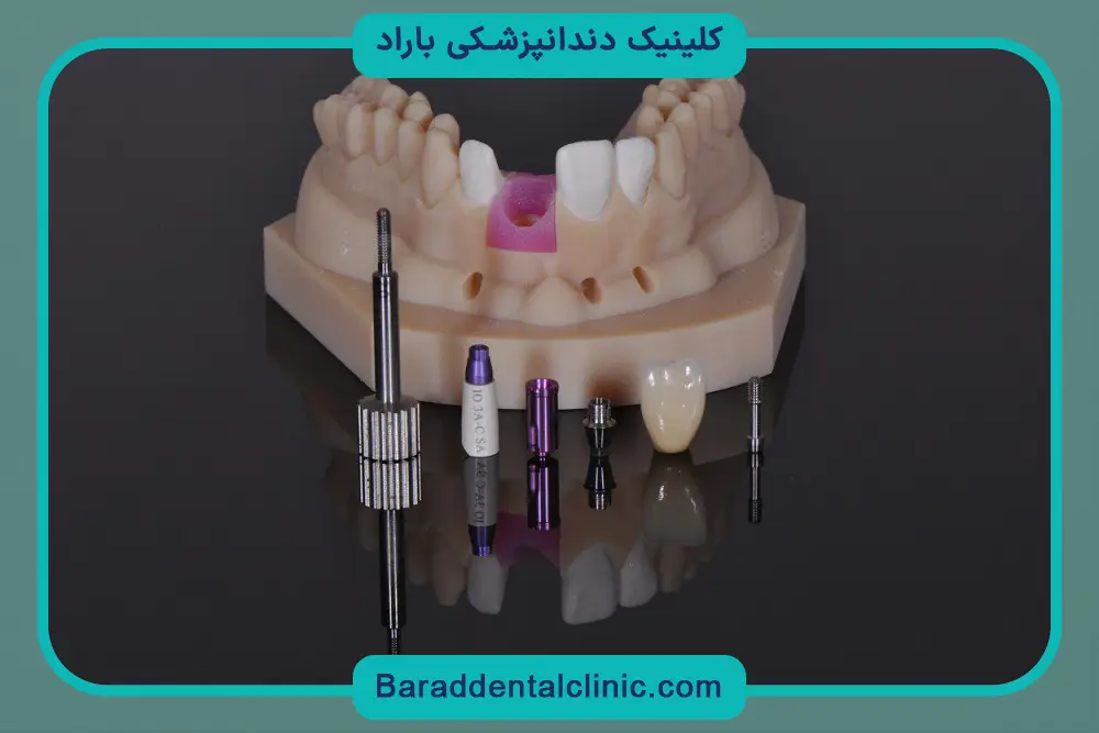 فرق ایمپلنت دیجیتال با پانچ