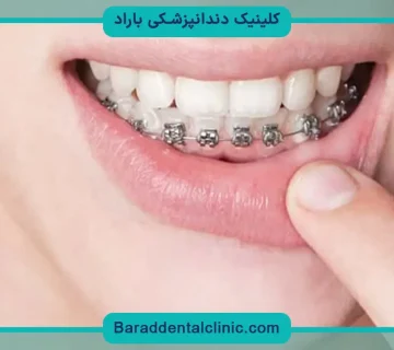 قیمت سیم کشی دندان فک پایین