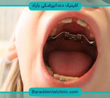 سیم کشی دندان تا چند سال طول میکشد