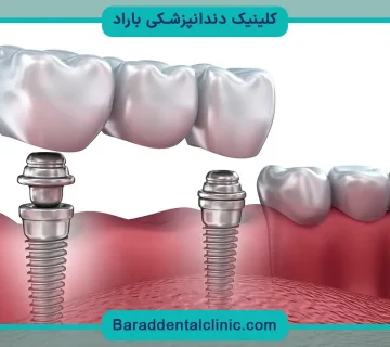 ایمپلنت دیجیتال دندان چیست