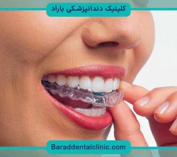 براکت متحرک دندان