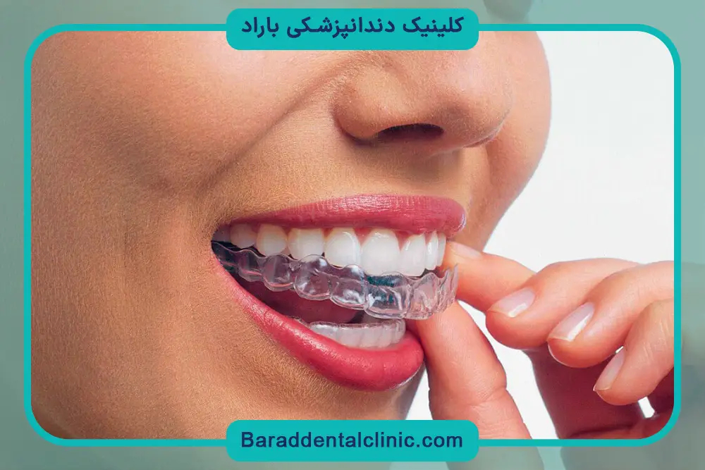 براکت متحرک دندان