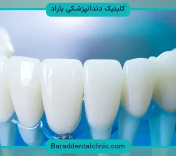 ایمپلنت دیجیتال چند روز طول میکشد؟