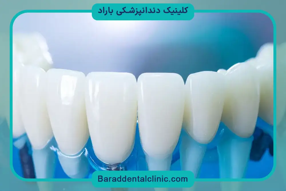 ایمپلنت دیجیتال چند روز طول میکشد؟