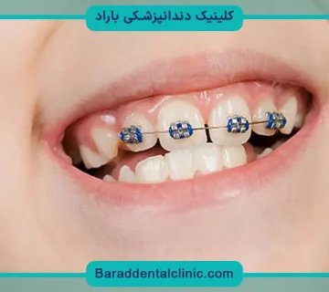 سیم کشی دندان تکی