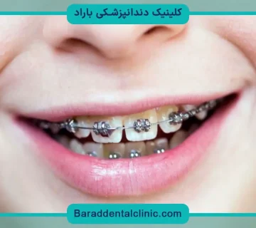 براکت گذاری دندان