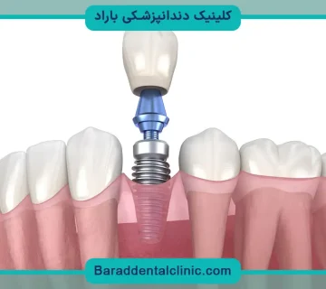 تفاوت ایمپلنت دیجیتال و معمولی