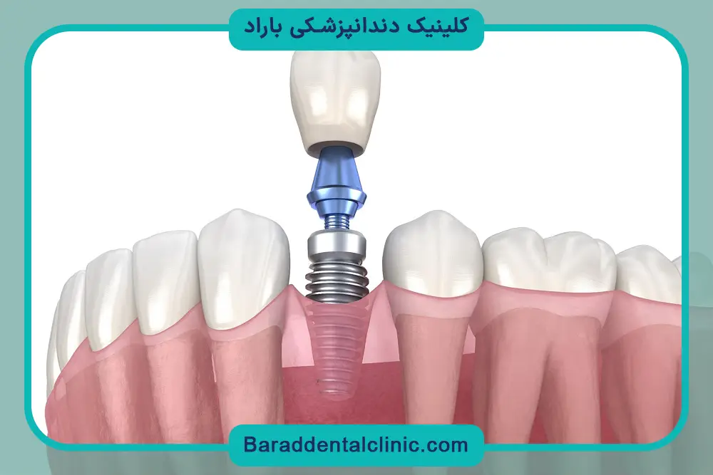 تفاوت ایمپلنت دیجیتال و معمولی