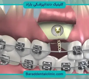 براکت دندان نهفته