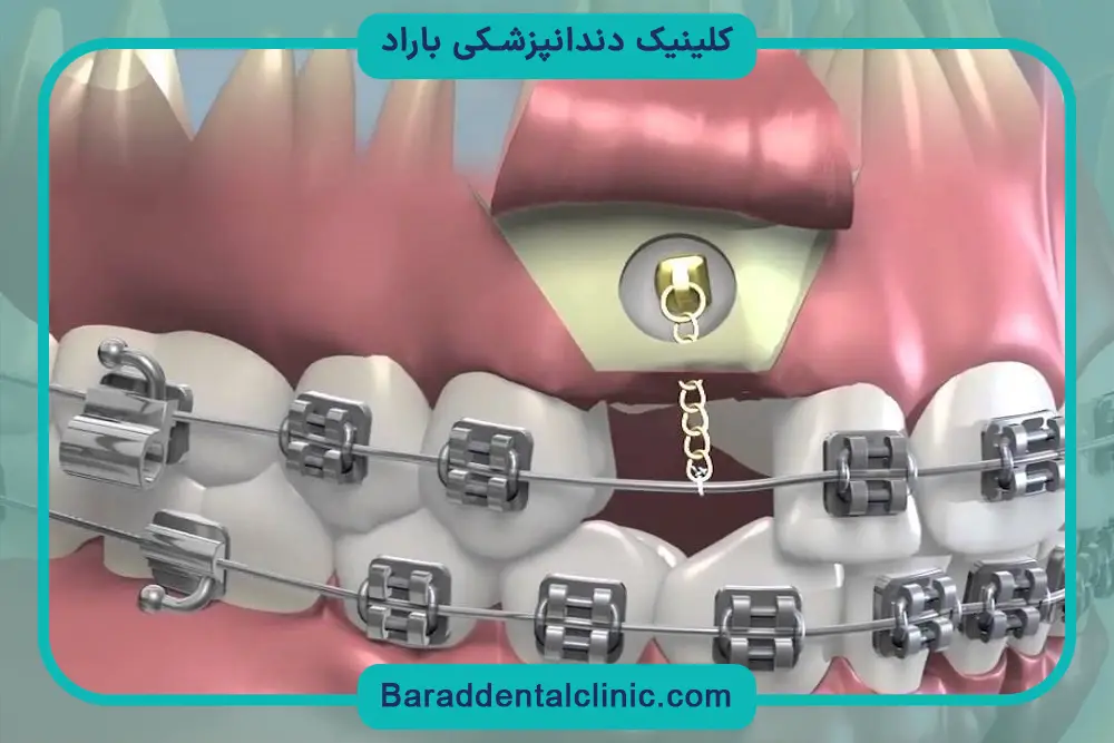 براکت دندان نهفته