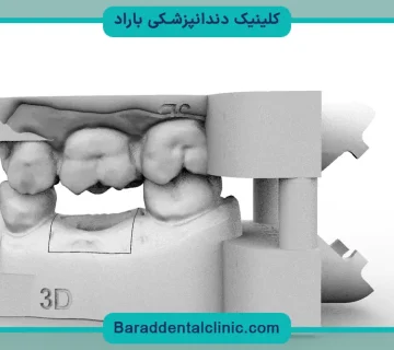 ایمپلنت دیجیتال خوبه یا سنتی