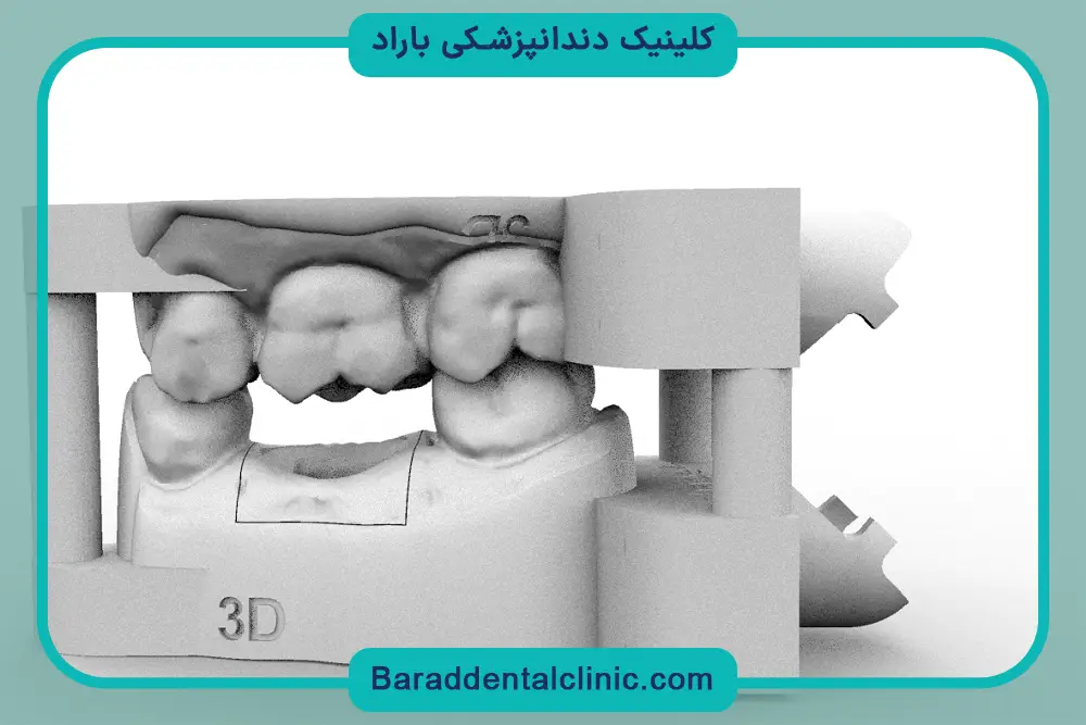 ایمپلنت دیجیتال خوبه یا سنتی