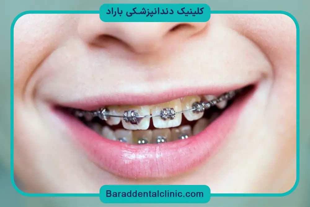 براکت گذاری دندان