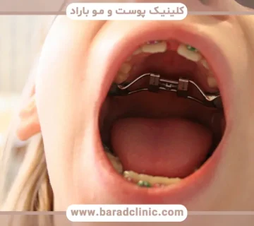 سیم کشی دندان تا چه سنی است؟