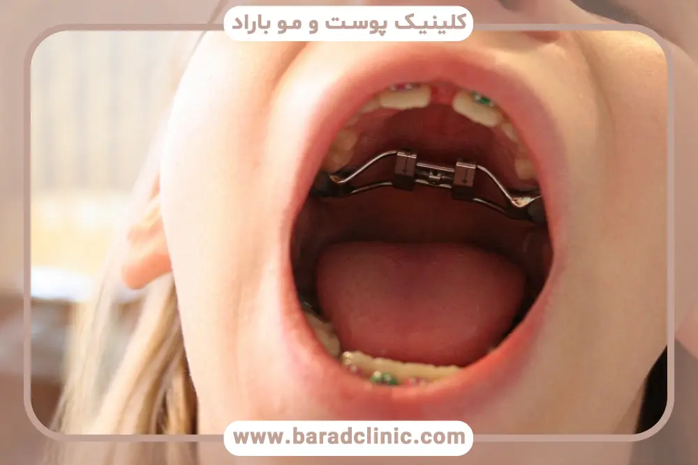 سیم کشی دندان تا چه سنی است؟