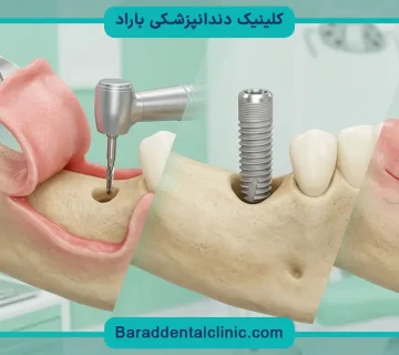 ایمپلنت فوری دیجیتال چیست؟