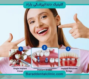 ایمپلنت دیجیتال چقدر طول میکشه؟