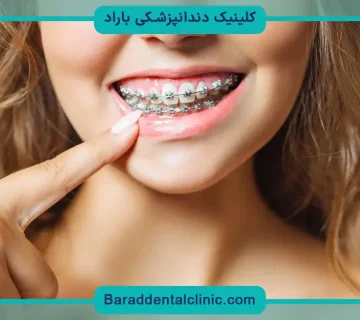 سیم کشی دندان جدید