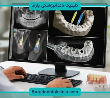 عمر ایمپلنت دیجیتال