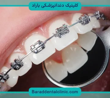 قیمت سیم کشی چهار دندان جلو