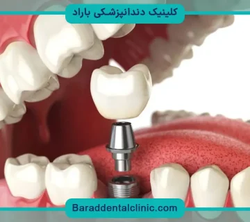 ایمپلنت تک دندان