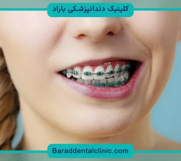 قیمت سیم کشی دندان جلو