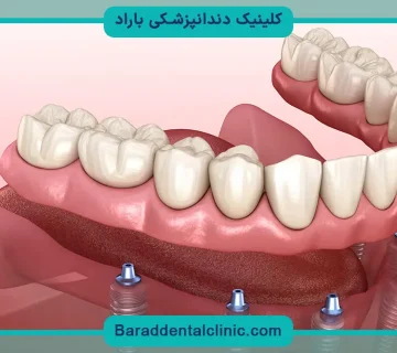 ایمپلنت تمام فک