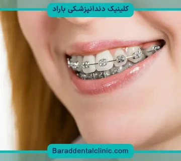 سیم کشی دندان در تهران