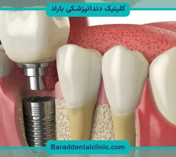 ایمپلنت فوری دندان