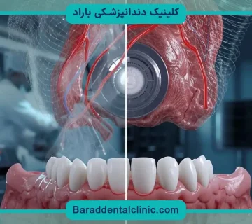 معایب ایمپلنت دیجیتال