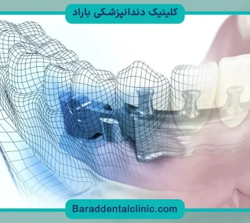 ایمپلنت جدید دیجیتال
