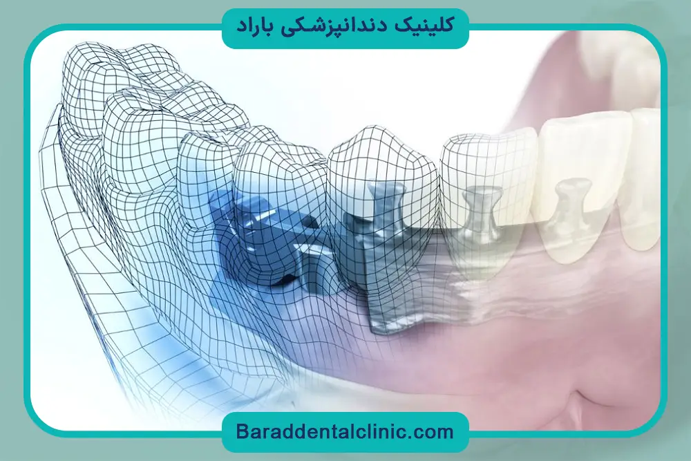 ایمپلنت جدید دیجیتال