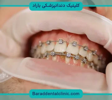 سیم کشی دندان شامل بیمه تکمیلی میشود