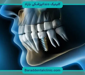 ایمپلنت دیجیتال دندان جلو